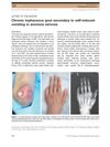 Chronic Tophaceous Gout Secondary to Self-Induced Vomiting in Anorexia Nervosa