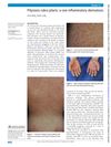 Pityriasis Rubra Pilaris: A Rare Inflammatory Dermatosis