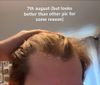 20M Concerned About Temple Regrowth with Minoxidil and Finasteride