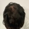 24M Seeking Advice on Minoxidil Treatment for Bald Spot after 2 Days Without Shampoo