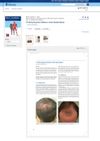 Following the Pattern: Hair Restoration
