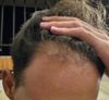 14 Months on Dutasteride &amp; Minoxidil, Seeking Advice to Improve Hairline Without Transplant