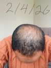 Male, 40 – 2.5 months on fin + min, any progress?