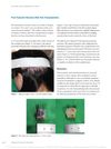 Post-Traumatic Neuroma After Hair Transplantation