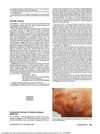 Cyclosporine Therapy for Bullous Erythema Multiforme