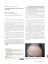 Frontal Fibrosing Alopecia: Follow-Up of a Brazilian Group