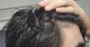 Is minoxidil enough to prevent further recession?