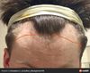 22 y.o. with Stable Hairline Using Minoxidil for 5 Months, Considering Hair Transplant?