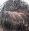 Should I start treatment or am I cooked?