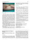 Metastatic Melanoma of the Tongue: A Rare Case