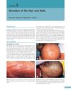 Disorders of the Hair and Nails