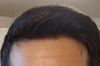 32M Uncertain About Dutasteride and Minoxidil Effects After Starting in January 2023
