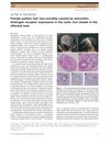 Female Pattern Hair Loss Possibly Caused by Tamoxifen: Androgen Receptor Expression in the Outer Root Sheath in the Affected Area
