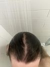 Week 0 to week 11 of Minoxidil, Microneedling, and Nizoral (19 M)