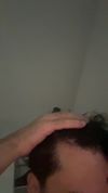 21M – Hair loss getting noticeably worse over the past year. What should I do?
