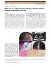Rare Case of Leydig Cell Tumor with Type I Diabetes Mellitus Causing Female Pattern Hair Loss