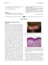 Solitary Fixed Drug Eruption Caused by Finasteride