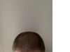 28M thinning, what should I do? Would like to restore my hairline