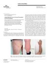 Isolated Body Hair Loss: An Unusual Presentation of Lichen Planopilaris