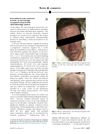 Kava-Induced Acute Cutaneous Toxicity: An Increasingly Recognized Characteristic Clinicohistologic Pattern