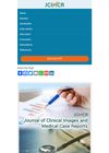 Fibrosing Alopecia in a Pattern Distribution After Hair Transplantation: A Case Report and Literature Review