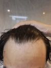 Is Minoxidil and finasteride only solution