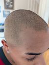 30M, 1 Year Balding, Can Finasteride and Minox Regrow Corners?