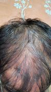Help from hair loss