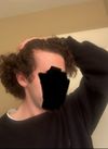 Is it possible to improve on finasteride/minoxidil initially and then worsen later?