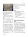 Extensive Cerebral Arteriovenous Malformation Presenting as a Small Cutaneous Lesion on the Forehead