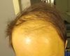 33M about to start treatment with oral dut + topical min. What can I hope for? Am I too late?