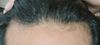 Increased Hairline Thinning 3 Months After Starting Finasteride