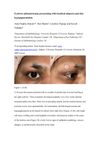 Eyebrow Pilomatrixoma Presenting With Localized Alopecia And Skin Hypopigmentation