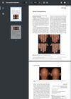 Successful Treatment of Alopecia Areata-Associated Trachyonychia With Baricitinib