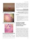 Isomorphic and Isotopic Phenomenon Occurring Simultaneously in a Case of Granuloma Annulare