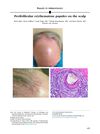 Perifollicular Erythematous Papules on the Scalp