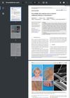 Uncombable Hair Syndrome Due to Maternal Uniparental Disomy of Chromosome 1