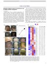 Extensive Alopecia Areata Is Reversed by IL-12/IL-23p40 Cytokine Antagonism