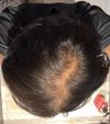 19M Considering Finasteride vs Only Minoxidil for Genetic Hair Loss