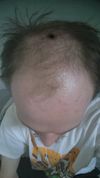 M28 Using Dutasteride and Oral Minoxidil for 3 Months – Seeking Advice for Front Hair Growth