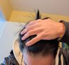 Is My Hair Shedding Back-to-Back After 1.5 Years on Finasteride?