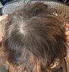 Curious About Temple Baby Hairs Connecting After 5 Months Treatment