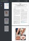 Alopecia Areata-Like Presentations With Mogamulizumab Therapy