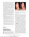 Multiple Myeloma-Associated Amyloidosis Presenting With Acrolocalized Acquired Cutis Laxa