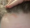Worsening Hair Thinning Despite Finasteride and Minoxidil Routine (20M)