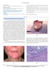 Strumal Carcinoid Tumor of the Ovary