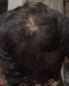 16 year old Hairloss, Min for 6 months