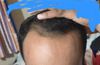 25 years old, which hair style should have tried at this point of time? Or should i go for full bald? Advice? Or Hair Transplant?