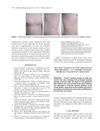 Traction Alopecia in Two Adolescent Sikh Brothers: An Underrecognized Problem Unmasked by Migration