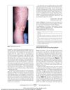 Finasteride-Induced Pseudoporphyria
